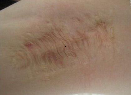 狐臭手术怎么做的视频,视频详解手术步骤与细节